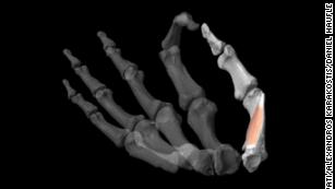 Thumbs gave human ancestors a 'formidable' advantage